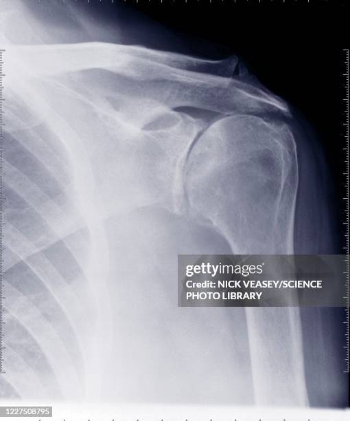 shoulder ribs and clavicle, x-ray - shoulder bone stock pictures, royalty-free photos & images
