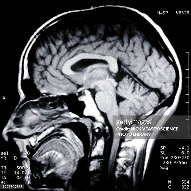 brain and skull from side, x-ray - skull xray no brain stock pictures, royalty-free photos & images