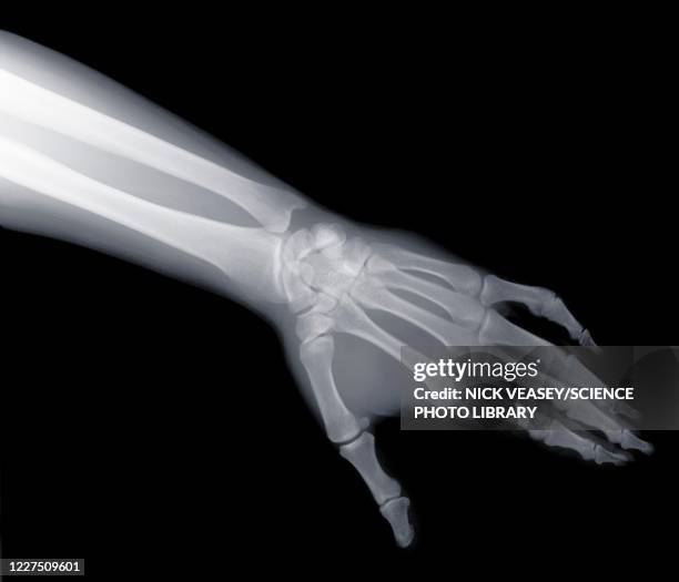 arm and hand, x-ray - x ray arm stock pictures, royalty-free photos & images