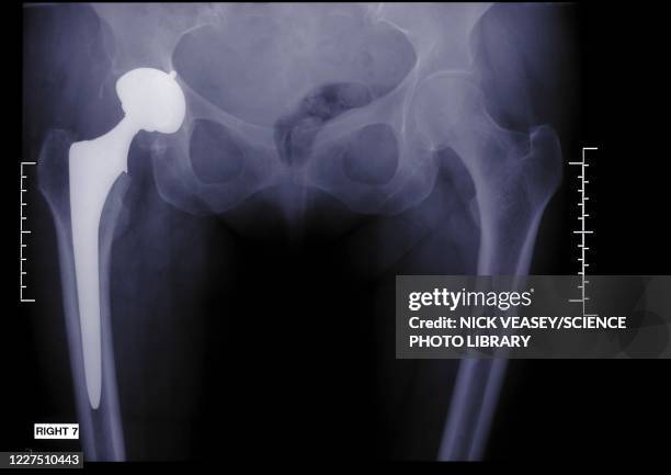 person with an artificial hip, x-ray - hips stock pictures, royalty-free photos & images