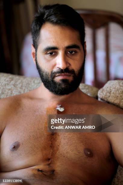 Firas Hamdan, a 33-year-old Lebanese lawyer, displays his scar after he had surgery on his heart following an injury with a lead pellet fired by...
