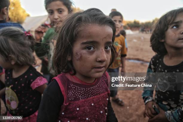 The spread of Leishmaniasis disease across children at Syrian refugee camp. PHOTOGRAPH BY Feature China / Future Publishing