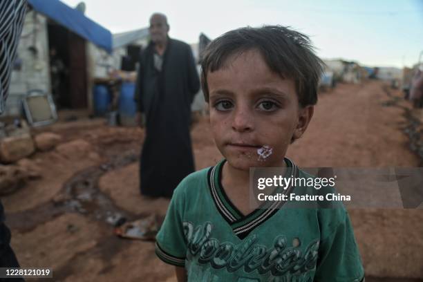 The spread of Leishmaniasis disease across children at Syrian refugee camp. PHOTOGRAPH BY Feature China / Future Publishing