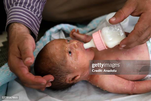 Syrian baby Mutaz who is just 18 days old with fish scale disease is seen as he drinks milk from a nursing bottle in Sermin district of Idlib, Syria...