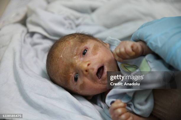 Day-old Syrian baby Mutaz with fish scale disease is seen in Hatay, Turkey on August 24, 2020. Baby Mutaz were brought to Turkey with his family, who...