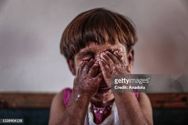 Year-old Meryem Es-Sah with a severe skin disease "Pemphigus" since she was 3-month old is seen in Idlib, Syria on September 24, 2020. She maintains...
