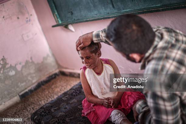 Year-old Meryem Es-Sah with a severe skin disease "Pemphigus" since she was 3-month old is seen with her father in Idlib, Syria on September 24,...