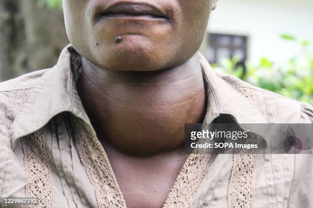 Irine Akinyi, 28 year old, a victim of lead poisoning in Uwino Uhuru Village of Changamwe seen after an interview with the press. She suffers from...