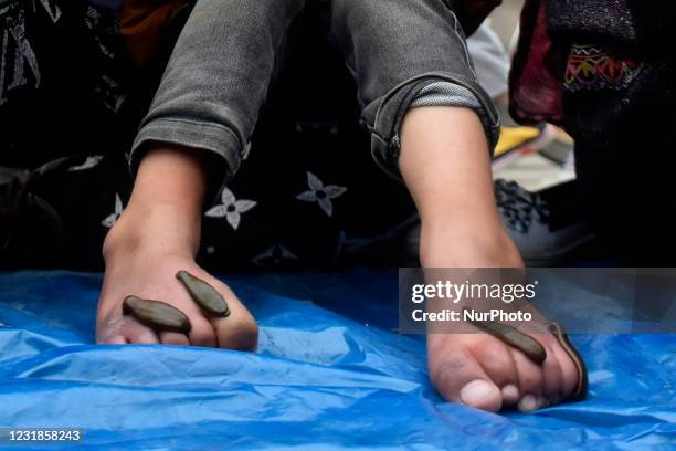 Kashmiri people take leech therapy on the eve of Nauroz in Srinagar, Indian Administered Kashmir on 21 March 2021. Leech therapy locally known Derkhe...