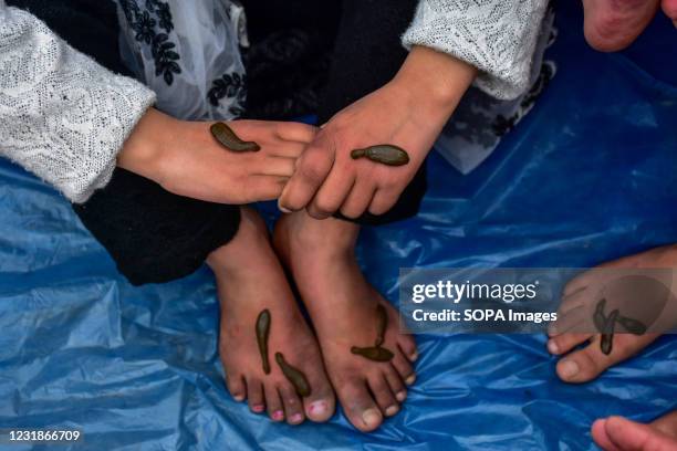 Patient receives leech therapy in Srinagar. Every year traditional health workers in Kashmir use leeches to treat people suffering from skin...