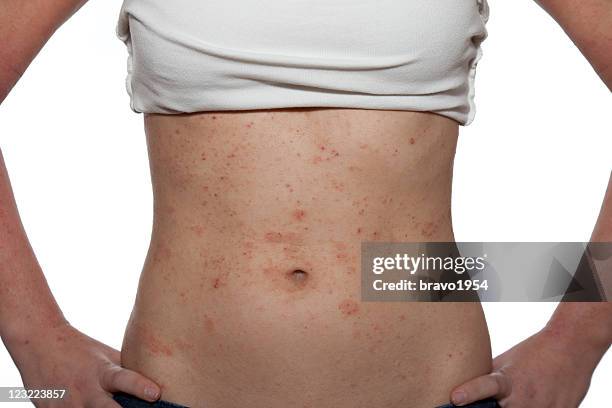 dermatitis - eczema stock pictures, royalty-free photos & images