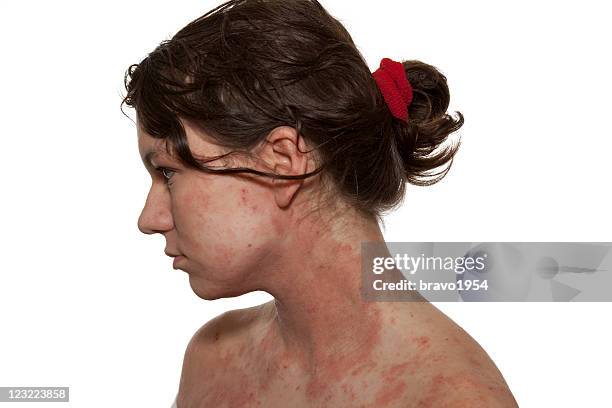 atopic dermatitis - atopic dermatitis stock-fotos und bilder