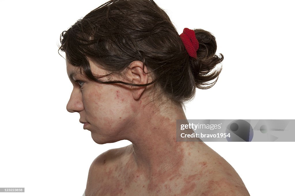 Dermatite atopica