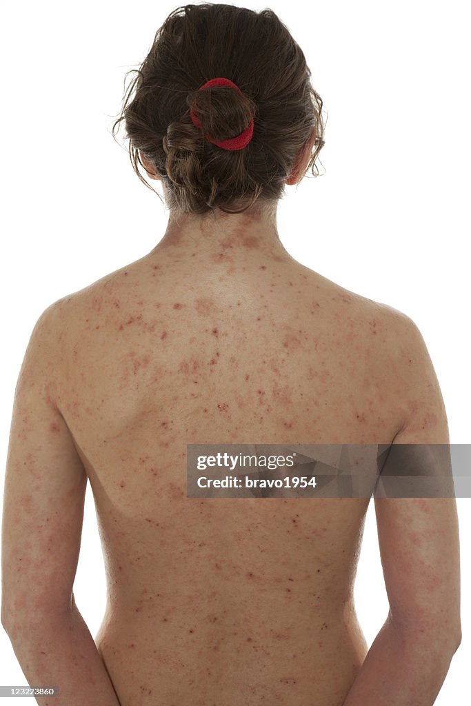 Atopic dermatitis