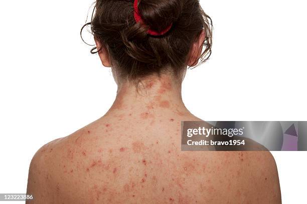 atopic dermatitis - eczema stock pictures, royalty-free photos & images