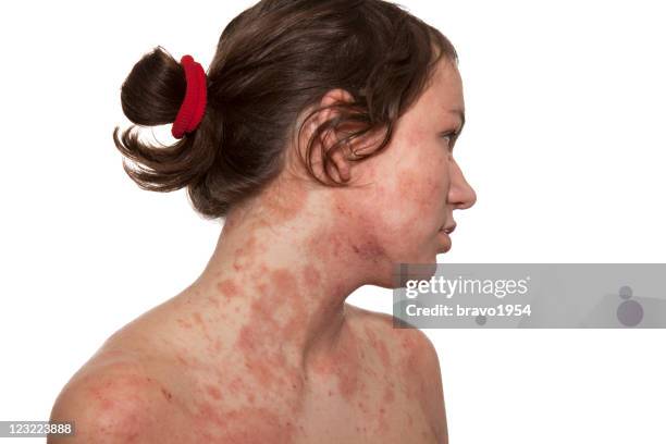 atopic dermatitis - atopic dermatitis stock pictures, royalty-free photos & images