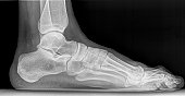 X-Ray Image: Foot