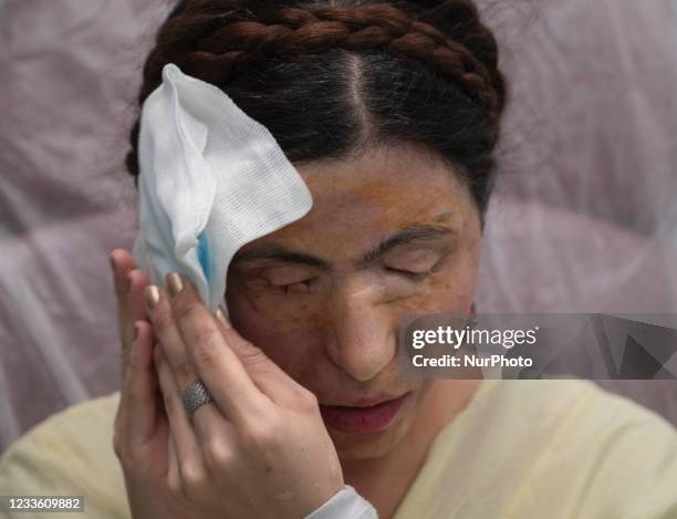 Masoumeh Ataei who is a victim of an acid attack, holds an Ice compress on her face after the restorative operation of the fat injection under the...