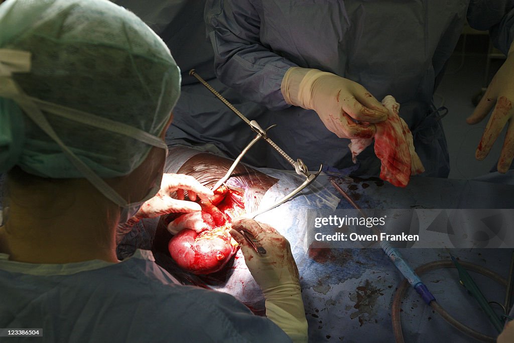 Kidney transplant operation