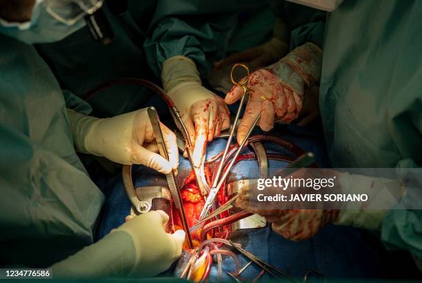 Cardiovascular surgeons Susana Villar and Juan Esteban de Villarreal perform a heart transplant at an operating theatre in Puerta de Hierro...