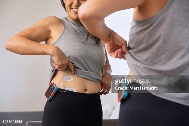 In this photo illustration, a smiling young woman looks in the mirror at her tubed insulin pump, infusion site, and continuous glucose monitor.