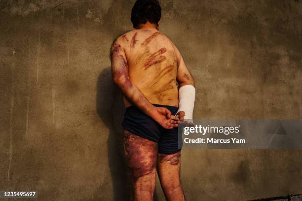 Habib Farzad a PhD scholar in Sociology, display his injuries sustained during detention, after he was arrested by Taliban soldiers while attending a...