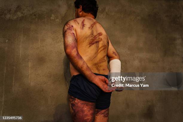 Habib Farzad a PhD scholar in Sociology, display his injuries sustained during detention, after he was arrested by Taliban soldiers while attending a...