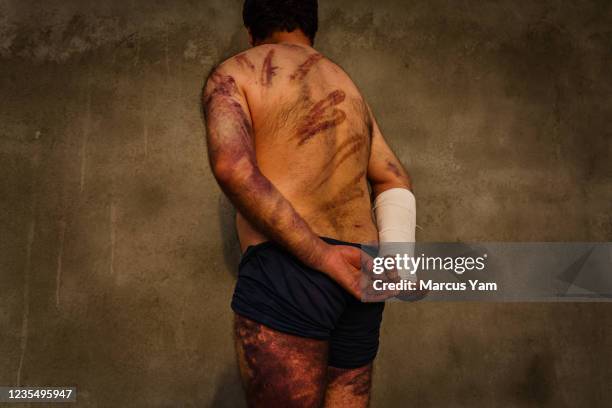 Habib Farzad a PhD scholar in Sociology, display his injuries sustained during detention, after he was arrested by Taliban soldiers while attending a...