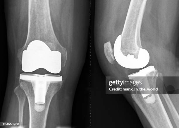 insgesamt knie erneuerung - künstliches kniegelenk stock-fotos und bilder
