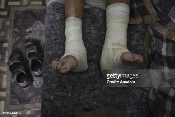 Leprosy patient is seen as patients suffer from lack of supplies at Curupaiti Colony Hospital in Rio de Janeiro, Brazil on November 21, 2021.The...