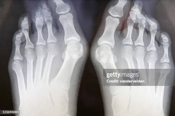 grunge con bunions radiografia del piede - hallux valgus foto e immagini stock