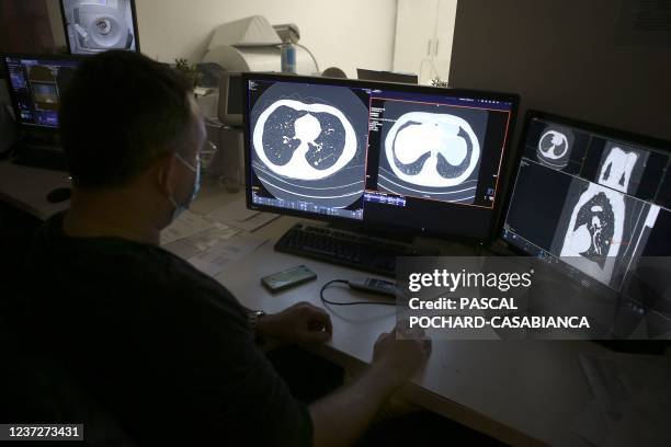 Radiologist Fredric Pedulla shows a nodule on a lung scan of a smoking person for the Acapulco experimentation in Ajaccio on December 16, 2021 on the...