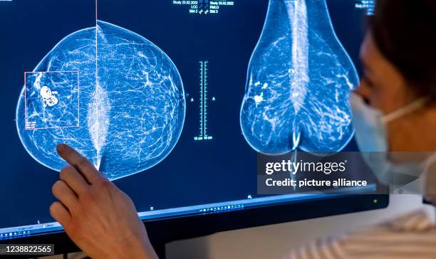 February 2022, Berlin: Medical personnel use a mammogram to examine a woman's breast for breast cancer. Photo: Hannibal Hanschke/dpa