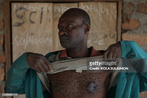 Cameroonian refugee who fled to Nigeria due to Cameroon separatist war in March 2019, show the scar he got from Cameroonian military after escaping...