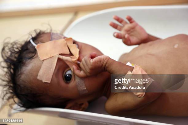 Yemeni baby suffering from malnutrition receives treatment with limited resources in the Department of Combating Malnutrition at Sabeen Hospital in...