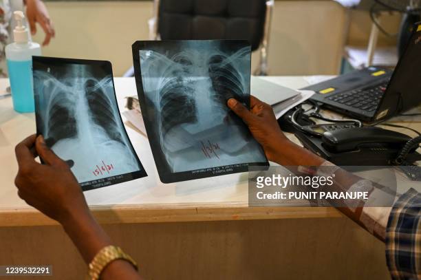 In this picture taken on March 22 Gautam Kamble, who is diagnosed with tuberculosis, holds chest x-rays during a routine consultation with a doctor...