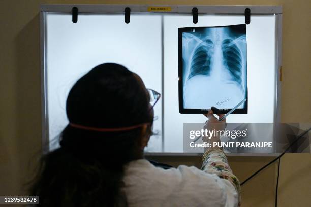 In this picture taken on March 22 a doctor checks Gautam Kamble's chest x-rays, who is diagnosed with tuberculosis, during a routine consultation at...