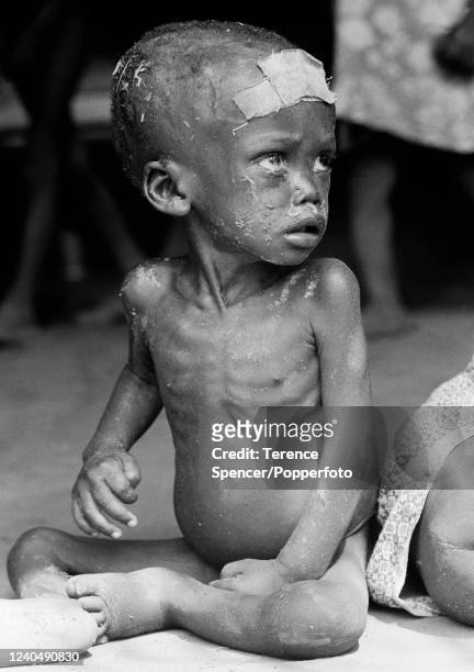 a-bandaged-and-starving-child-at-the-okporo-paediatric-hospital-during-the-final-stages-of.jpg?s=612x612&w=gi&k=20&c=OeeQ4Ku7ywjoVFb3lSKm9J814ZRO7PQwy2gjzTu4gJk=