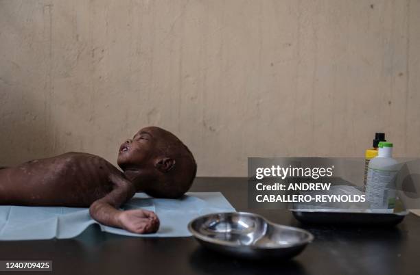 Graphic content / TOPSHOT - Severely malnourished son Ali Althaja, lies on a table before having his skin lesions washed in the emergency medial care...