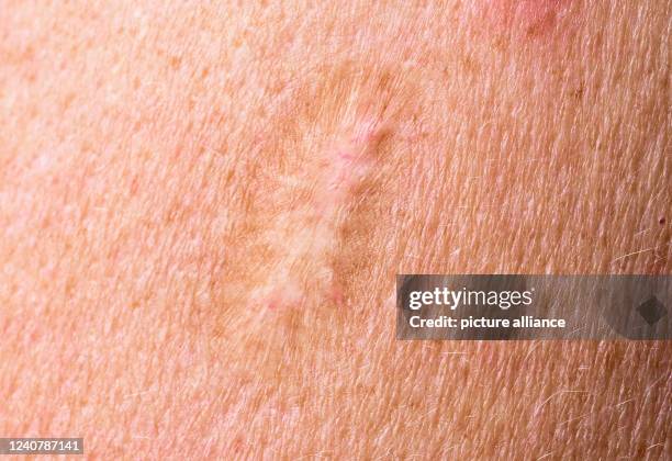 May 2022, Baden-Wuerttemberg, Stuttgart: A scar from a smallpox vaccination is visible on an upper arm. Smallpox was long considered one of the most...