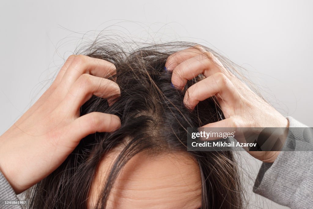 De hand jeukende hoofdhuid van de close-upvrouw, Het concept van de haarzorg