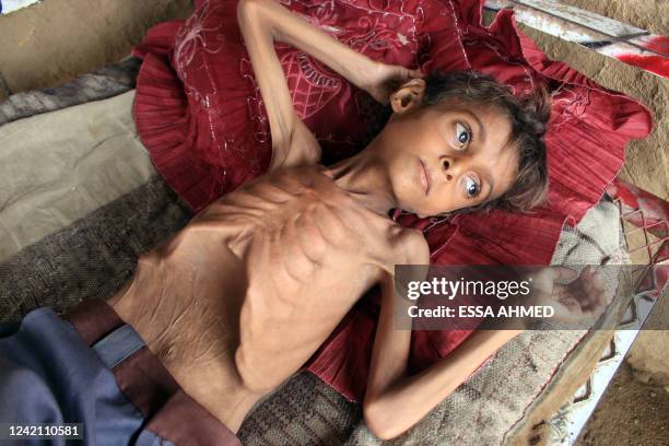 Graphic content / Hassan Razem, a ten-year-old child suffering from severe acute malnutrition is pictured in the Abs district of Yemen's northwestern...