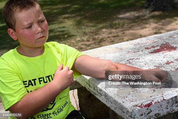 Ryland Ward shows off his gunshot wound on his left arm as he poses for a portrait at Hancock Park on June 8, 2022 in Lampasas, Texas. Ward was...