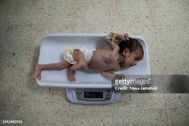 Young child is treated for malnutrition on a children’s ward at Indira Gandhi hospital on August 13, 2022 in Kabul, Afghanistan. The collapse of the...