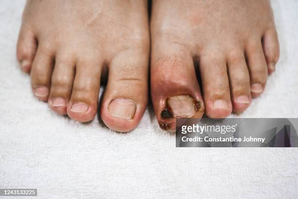 infected ingrown toenail comparison with a healthy one - drug evaluation stock pictures, royalty-free photos & images