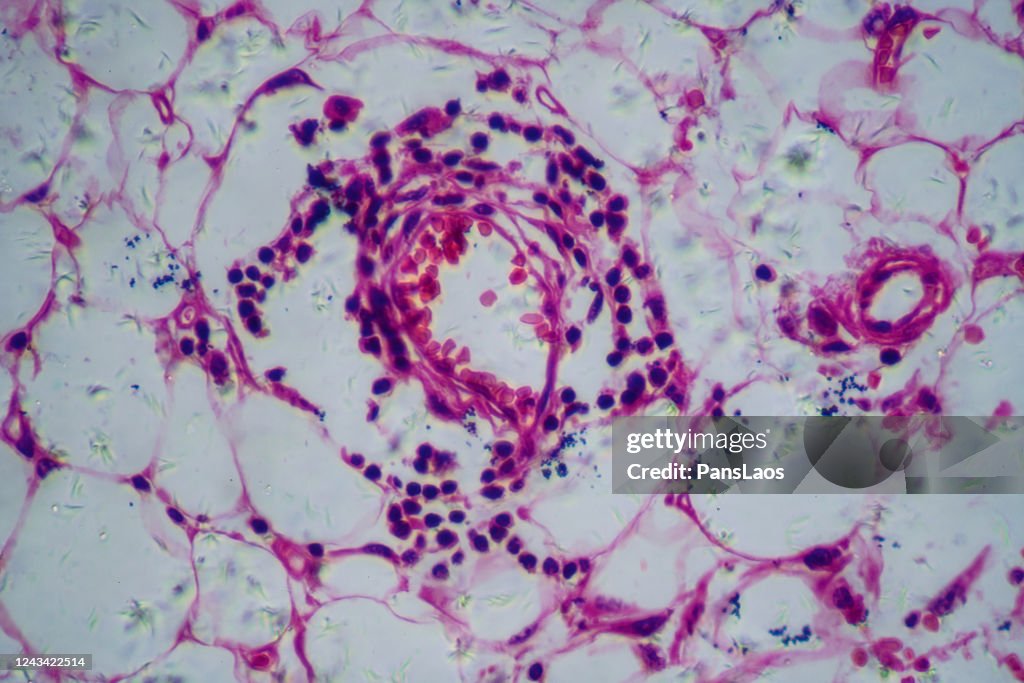 Lymph node carcinoma cells of human