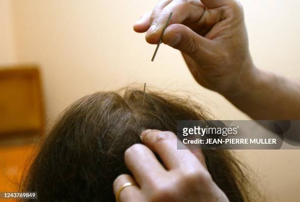 Un acupuncteur insère une aiguille sous la surface de la peau du crâne d'une patiente, le 22 octobre 2002 à Paris, le long d'un "méridien" pour...