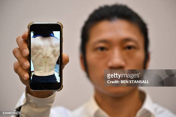 Hong Kong pro-democracy protester Bob Chan poses with a picture on his phone showing injuries following the assault at Manchester China Consulate...