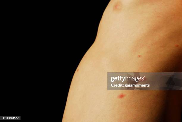 chickenpox - hot boy body stock pictures, royalty-free photos & images