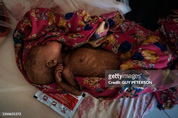 Abdirahman Nur lays on a bed in the ICU of Bay Regional Hospital in Baidoa, Somalia on November 9, 2022. - After four consecutive failed rainy...